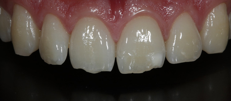 Before Teeth Straightening
